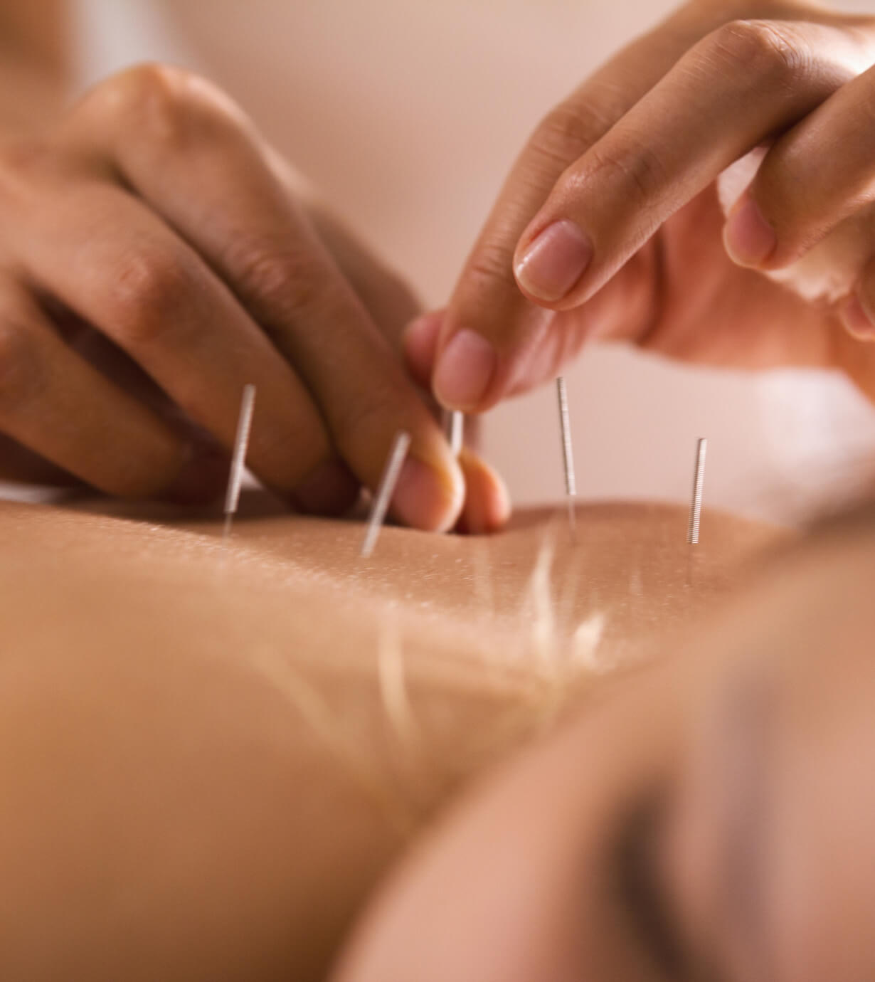 Acupuncture